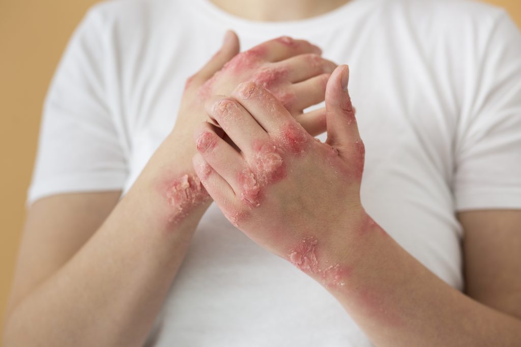 Eczema Treatment